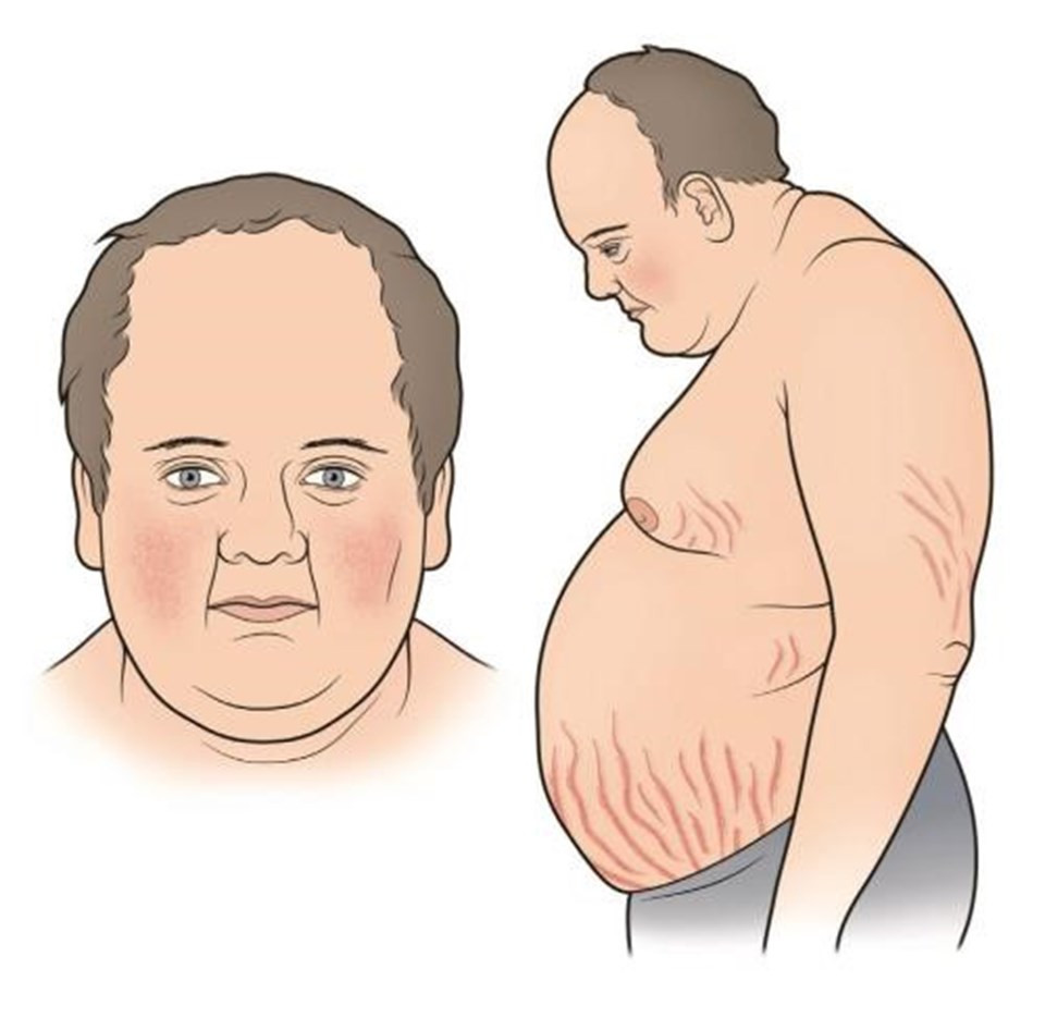 Синдром кушинга