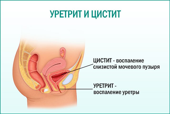 Лечение уретрита