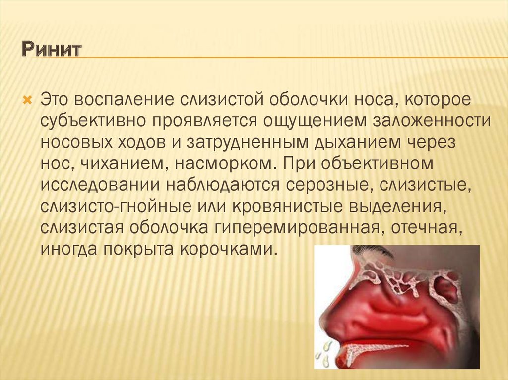 Ринит
